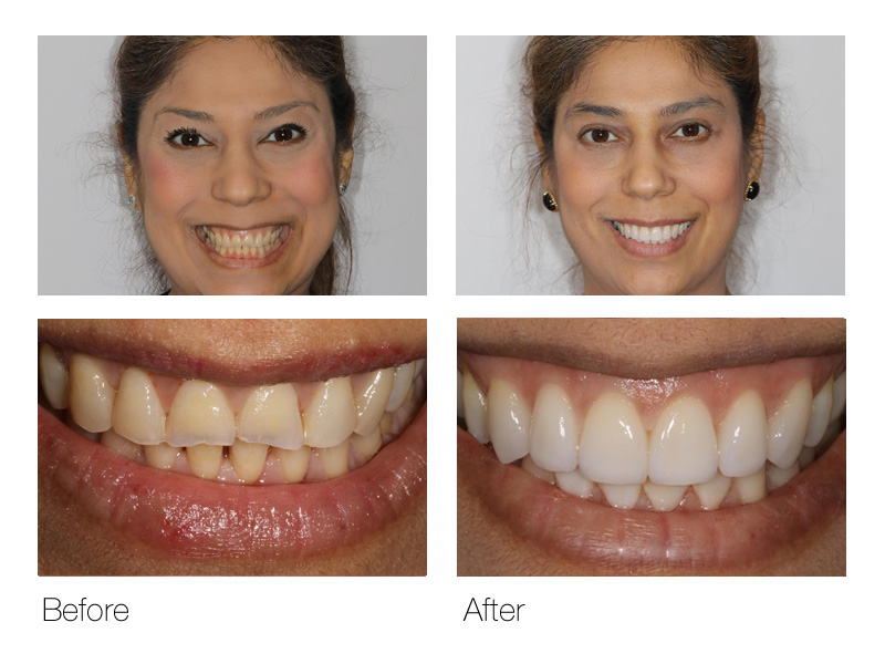 Before and After Cosmetic Dentistry