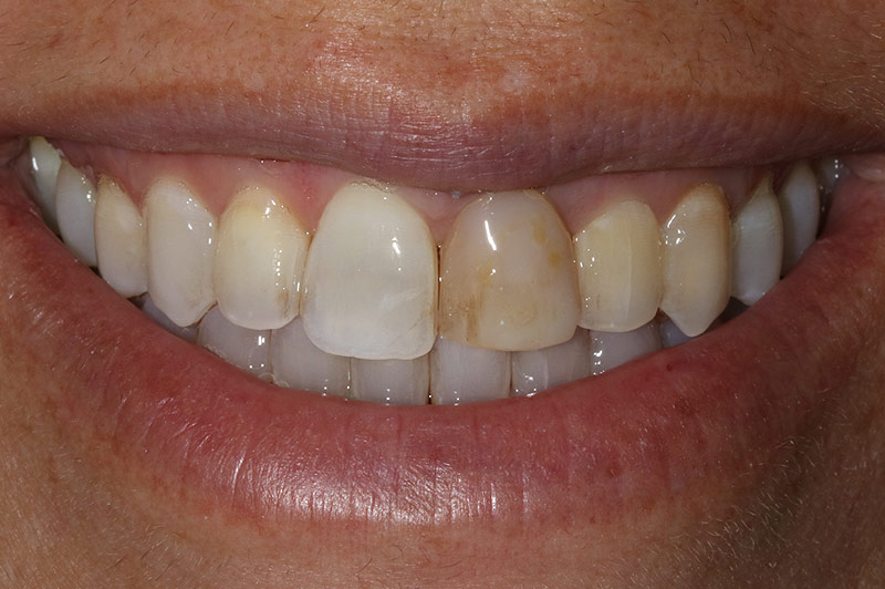Single Porcelain Veneer and Single Natural Crown and Whitening.