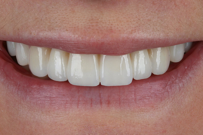After Six Unit Porcelain Bridge & Four Resin Veneers Teeth Only