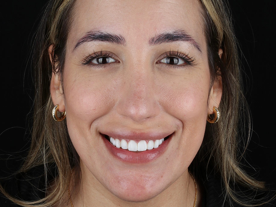 After Gum Contouring and Ten Composite Resin Veneers Face