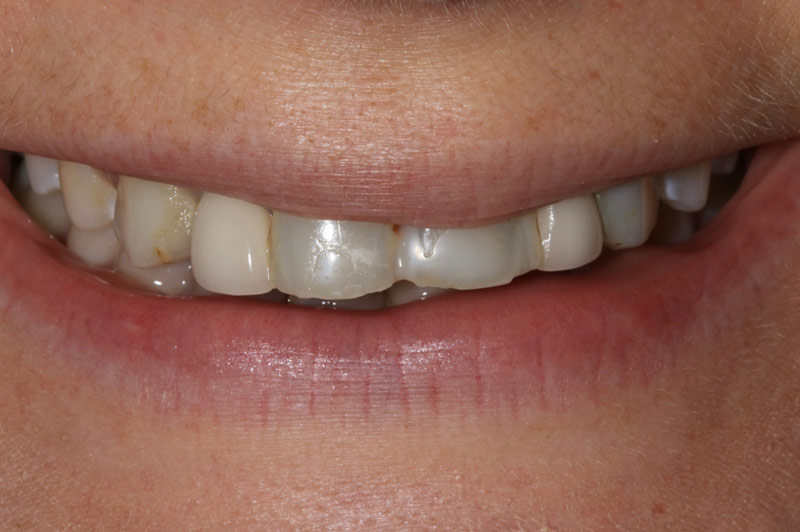 Before Six Unit Porcelain Bridge & Four Resin Veneers Teeth Only