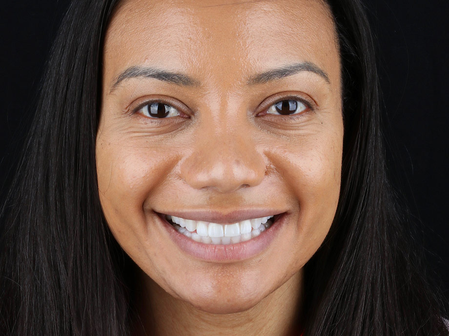 Gum Contouring and Four Porcelain Veneers After Treatment