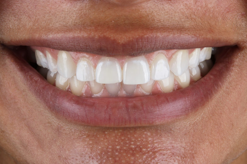 Gum Contouring and Four Porcelain Veneers Before Teeth Image