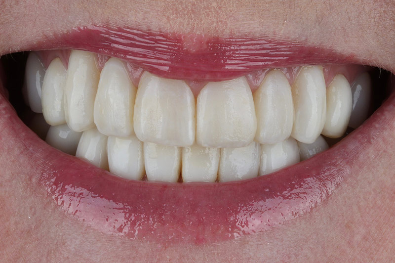 After 8 Direct Composite Veneers Teeth
