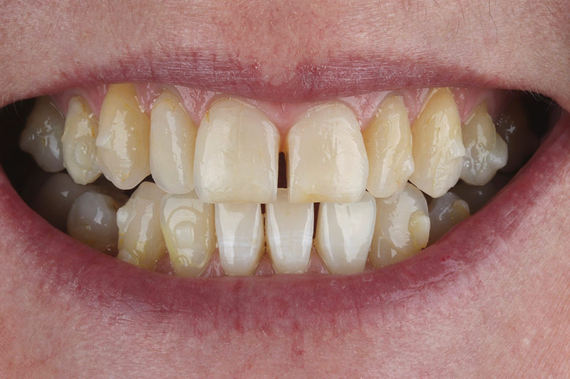 Before 8 Direct Composite Veneers Teeth