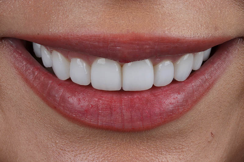 Teeth After Laser Conturing and Veneers