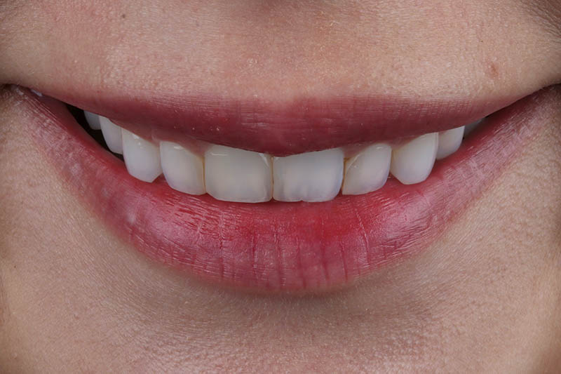 Teeth Before Laser Conturing and Veneers