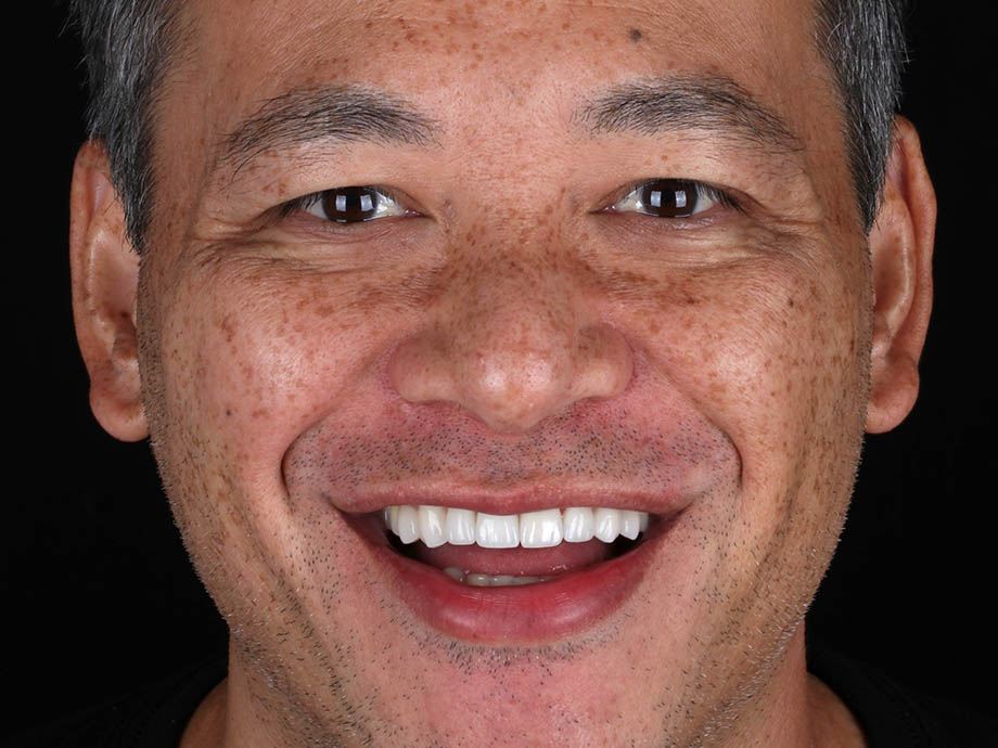 After 8 upper porcelain veneers, 1 lower crown, and lower teeth contouring