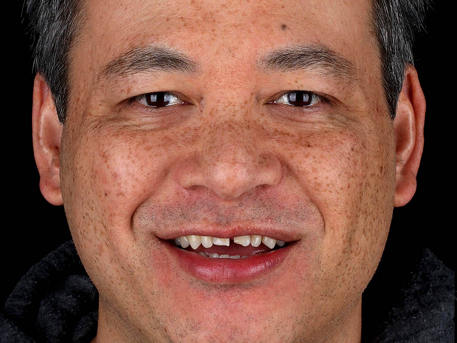Before 8 upper porcelain veneers, 1 lower crown, and lower teeth contouring