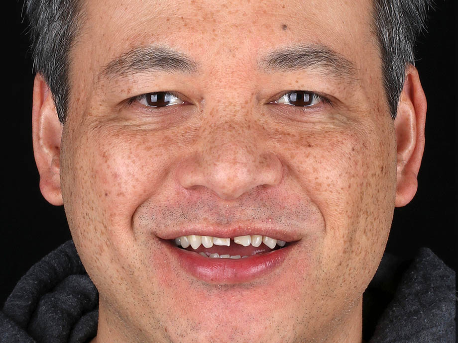 Before 8 upper porcelain veneers, 1 lower crown, and lower teeth contouring