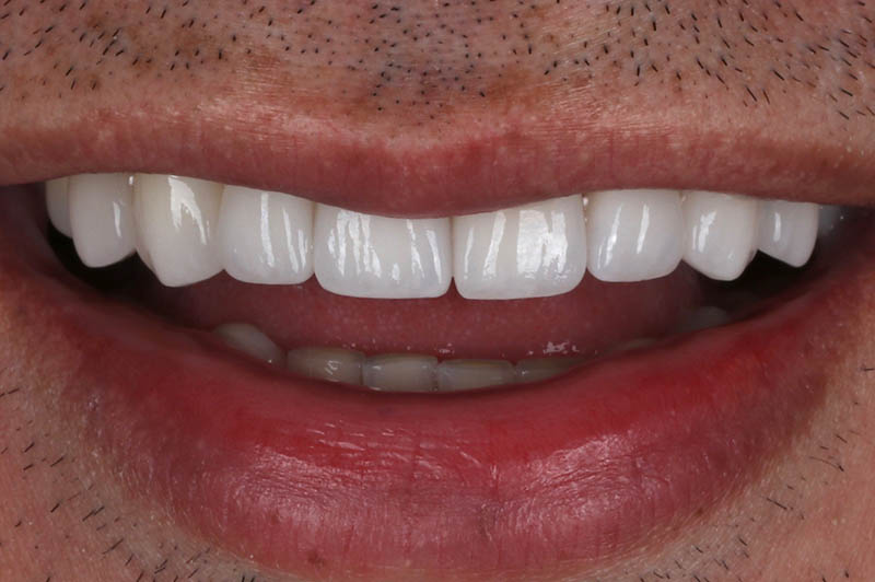 Teeth after upper veneers crown, and conturing