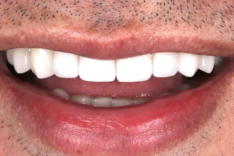 Teeth after upper veneers crown, and conturing