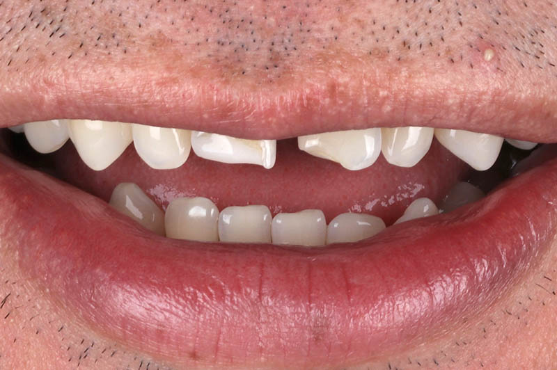 Teeth before upper veneers crown, and conturing